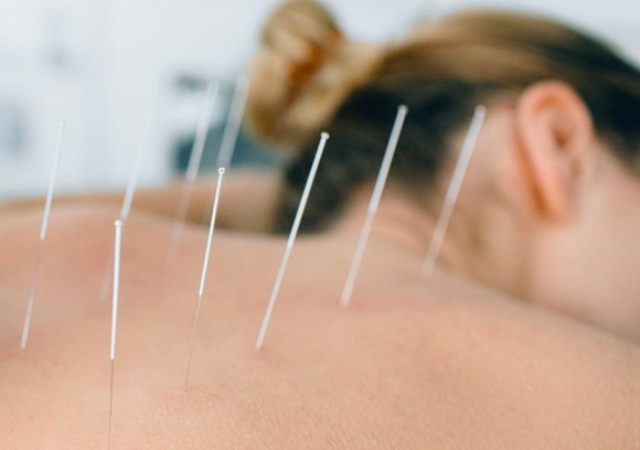 acupuncture